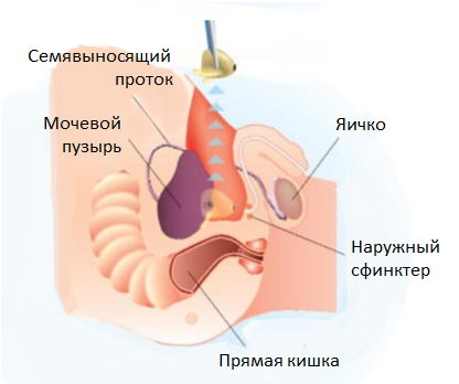 Рак предстательной железы лечение в петербурге thumbnail